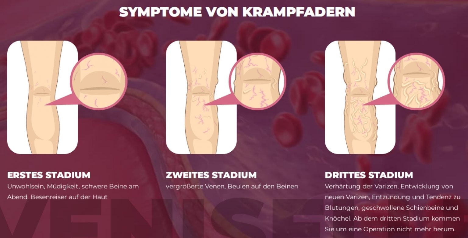ᐉ Veniselle Wirkung, Anwendung, Erfahrungen, Nebenwirkungen, Bewertung